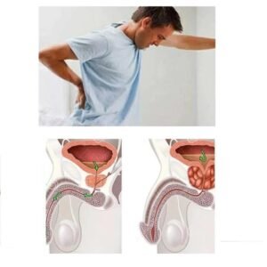 Prostatic Bladder Control Urinary Incontinence Patch